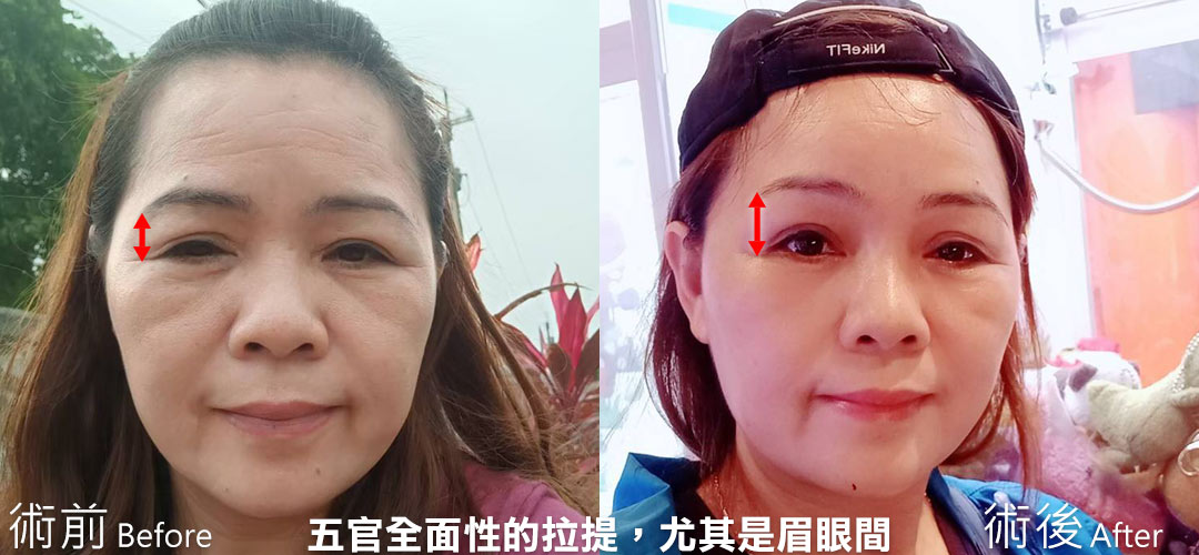 周爾康整形外科醫師內視鏡前額拉皮案例術前術後照抬頭紋對比