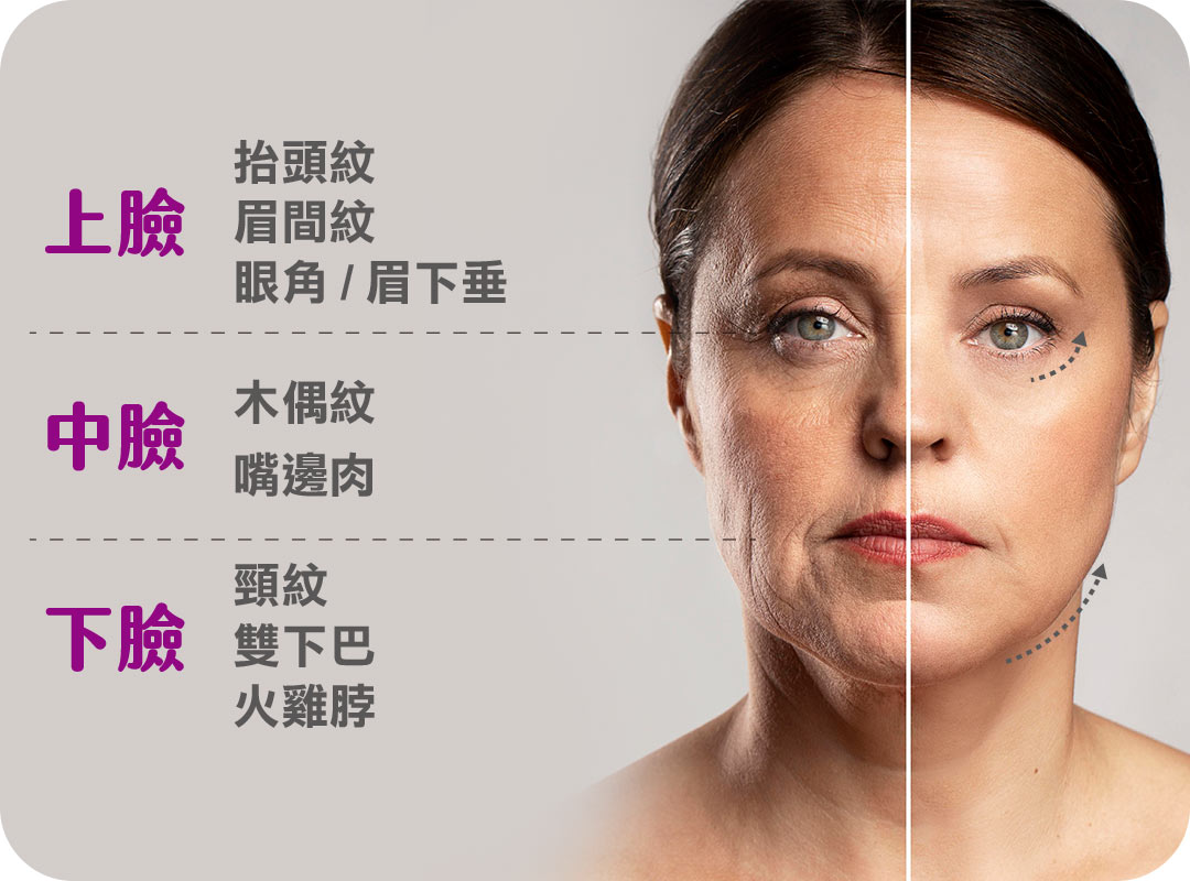 臉部拉皮手術(額頭拉皮|中下臉拉皮|頸部拉皮) 臉部拉皮手術(額頭拉皮|中下臉拉皮|頸部拉皮)